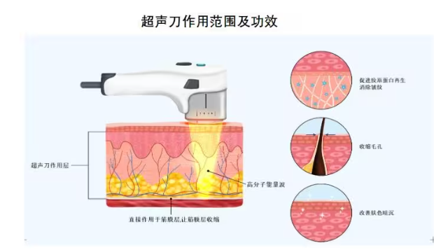 超声刀医美器械是通过超声刀头所产生的高强度聚焦式超声波，并将声波聚于一点，进而产生高能量，作用于不同皮肤部位，最终起到治疗效果的医美器械。超声刀作用的皮肤深度不同，效果也不同，作用于真皮浅层效果主要是改善皱纹，作用于真皮深层可以起到紧致作用，作用于筋膜层才是真正起到提升作用。而超声刀是目前医美光电治疗里，唯一能达到筋膜层深度的，这也是它区别于激光、射频的最大优势。