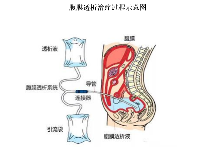 腹膜透析是利用人體腹膜作為半透膜，以腹腔作為交換空間，通過彌散和對(duì)流作用，清除體內(nèi)過多水分，代謝產(chǎn)物和毒素，達(dá)到血液凈化、替代腎臟功能的治療技術(shù)。腹膜透析是治療急性腎損傷和慢性腎衰竭的有效腎臟替代治療方法之一，適用于各種年齡段的患者，包括老年人、嬰幼兒和兒童等。