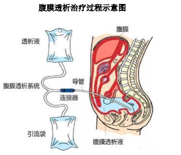 腹膜透析是利用人體腹膜作為半透膜，以腹腔作為交換空間，通過彌散和對流作用，清除體內(nèi)過多水分，代謝產(chǎn)物和毒素，達到血液凈化、替代腎臟功能的治療技術(shù)。