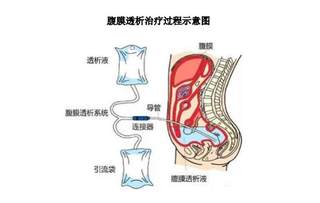 我国腹膜透析液行业分析：老龄化+居民支付能力增强 市场规模增长势头强劲